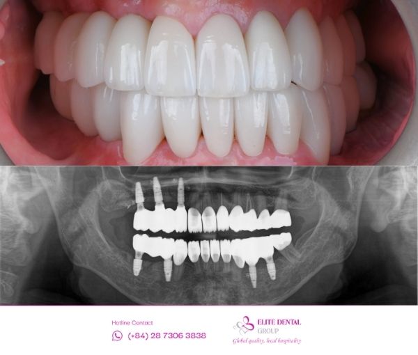 Trước và sau khi điều trị của anh Quang Tuyến