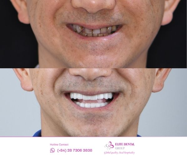 Hình ảnh trước và sau trồng răng Implant