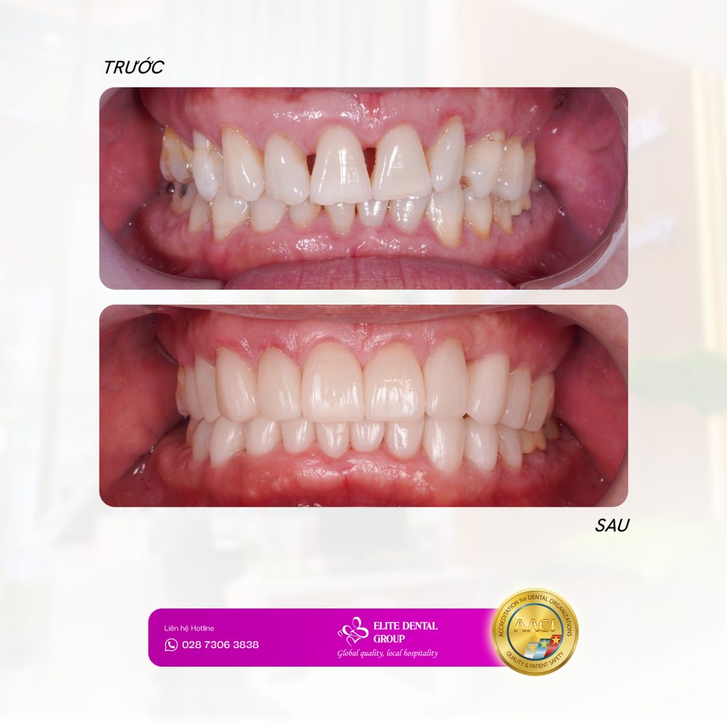 Nụ cười hài hòa sau phục hình Veneer