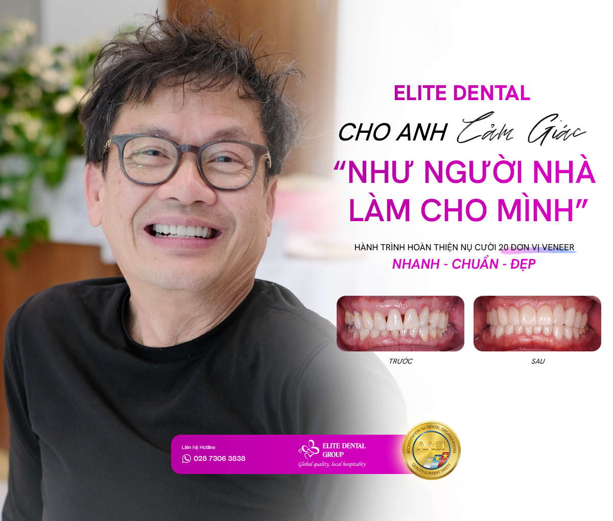 Hành trình hoàn thiện nụ cười 20 đơn vị Veneer từ Mỹ về Việt Nam