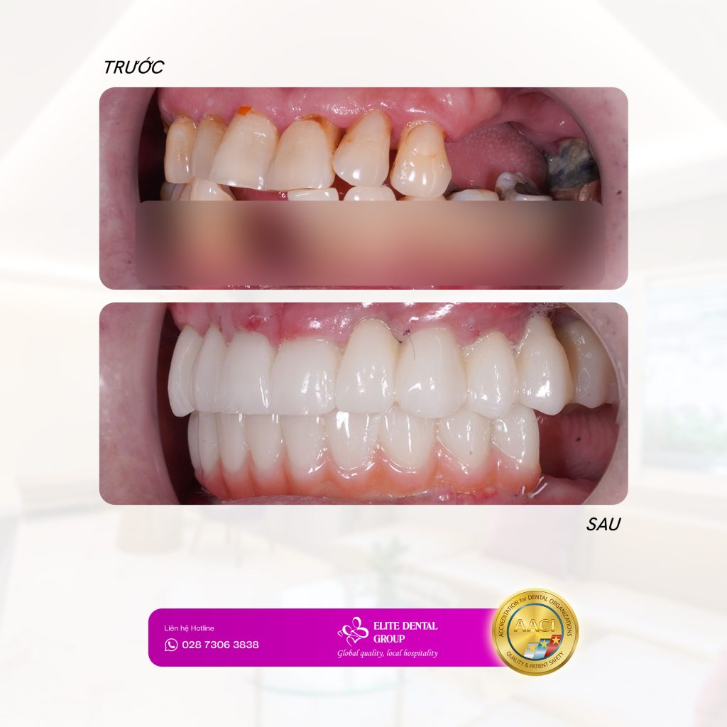 Hàm tạm tức thì khôi phục ăn nhai sau hai ngày