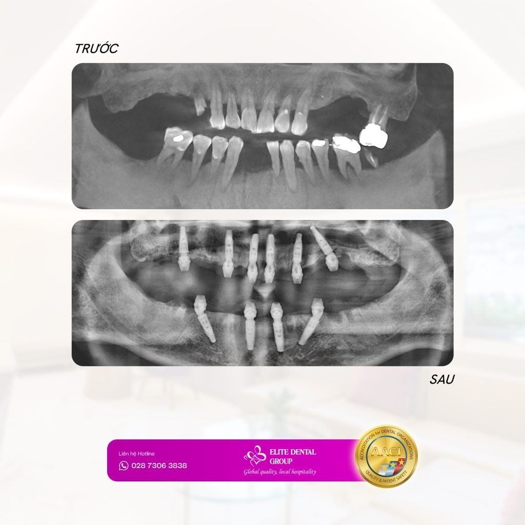 Kết quả sau giai đoạn phẫu thuật đã vượt xa mong đợi của chú và gia đình