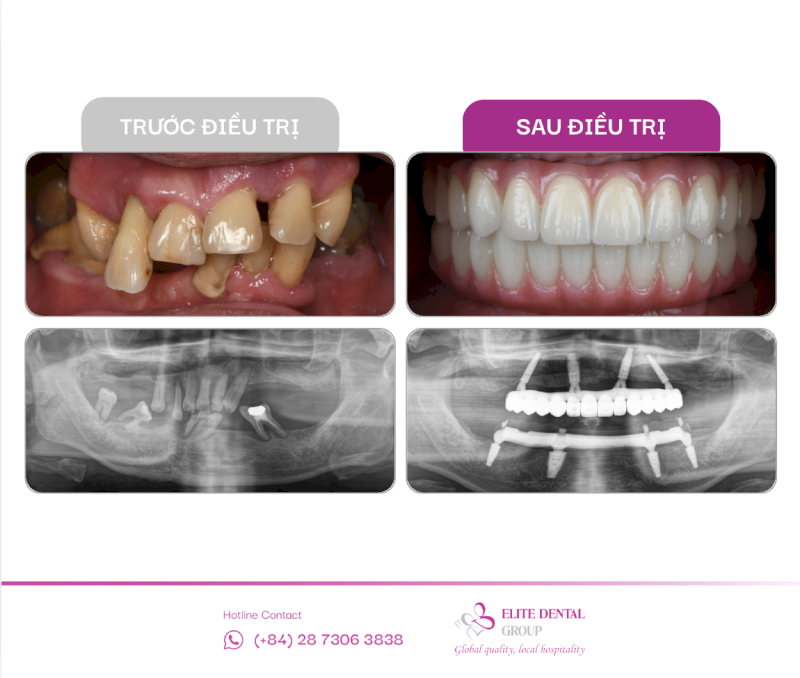 Trồng răng Implant là phương pháp phục hình răng đã mất
