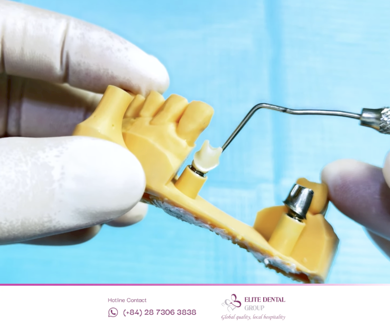 Khớp nối abutment zirconia bằng gốm đặc thích hợp cho răng cửa thẩm mỹ cao, giúp tăng độ khít sát và tuổi thọ Implant