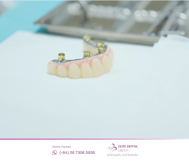 Mão răng sứ là phần răng giả trên cùng mô phỏng răng thật về hình dáng, kích thước và màu sắc dựa trên dấu quét 3D Trios