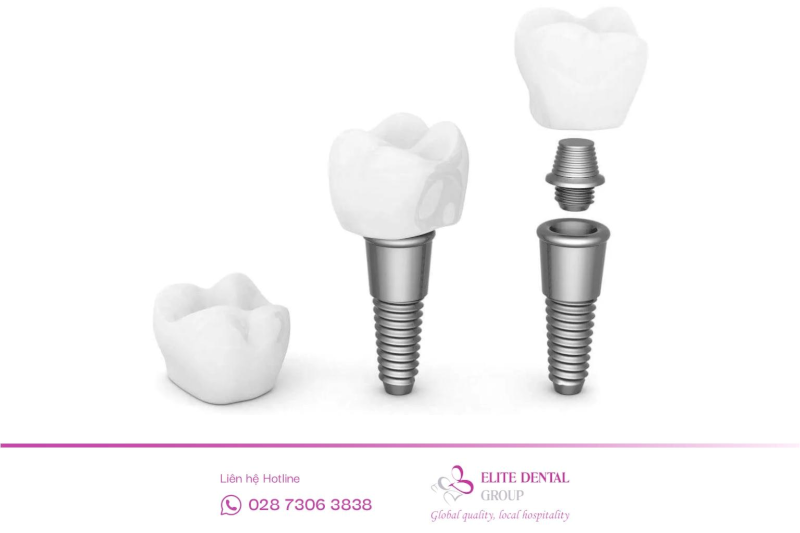 Implant có cấu tạo 3 bộ phận chính