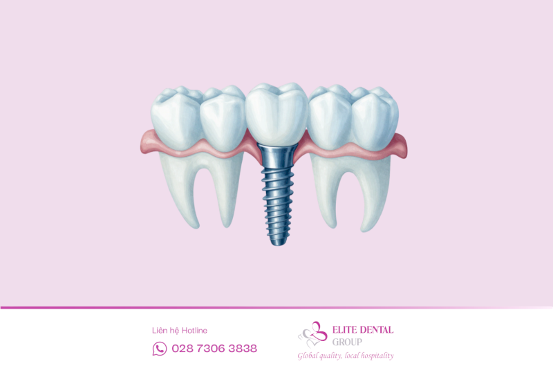Cấy ghép Implant là phương pháp đặt một trụ titanium vào xương hàm để thay thế cho chân răng đã mất.