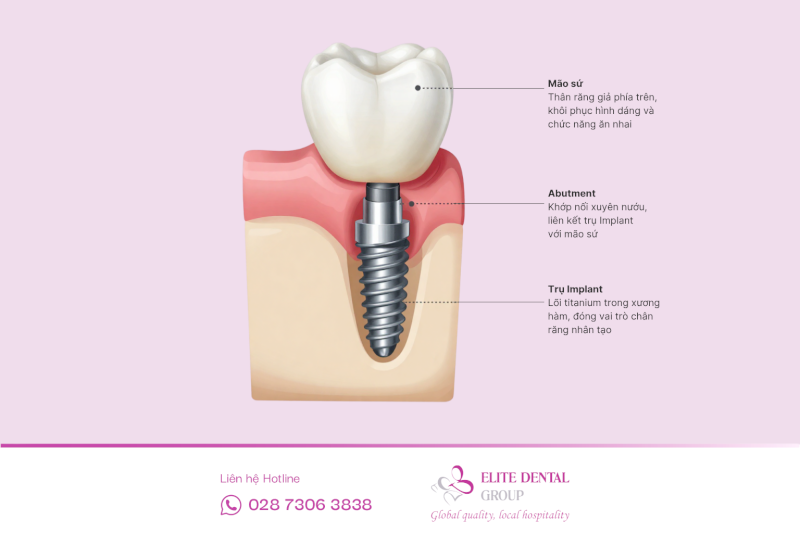 Một răng Implant hoàn chỉnh gồm ba bộ phận chính: Trụ Implant, Abutment, Mão sứ