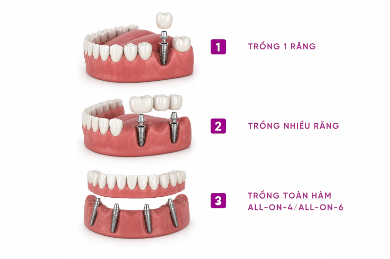 Cấy ghép Implant được triển khai theo ba hướng chính: Trồng 1 răng, trồng răng nhiều vị trí, trồng răng toàn hàm