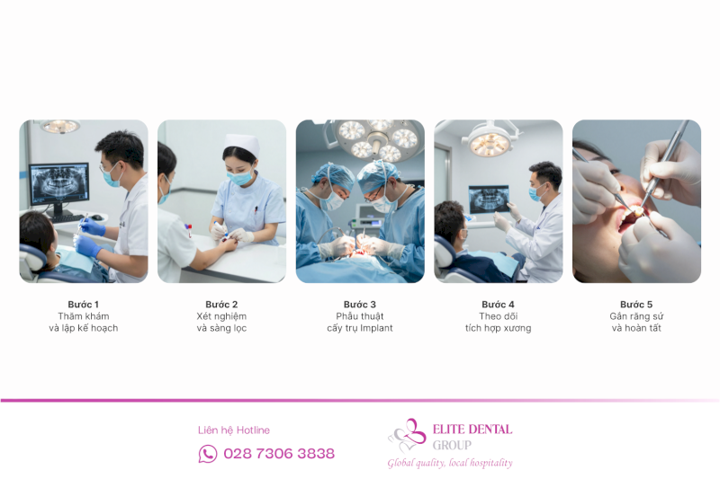 Một quy trình cấy ghép Implant chuẩn y khoa gồm 5 bước