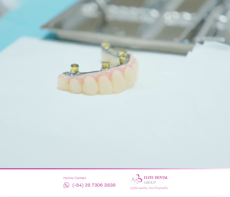 Vật liệu phục hình ảnh hưởng đến giá All-on-4 với các tùy chọn nâng cấp sườn titan răng sứ hoặc sườn zirconia