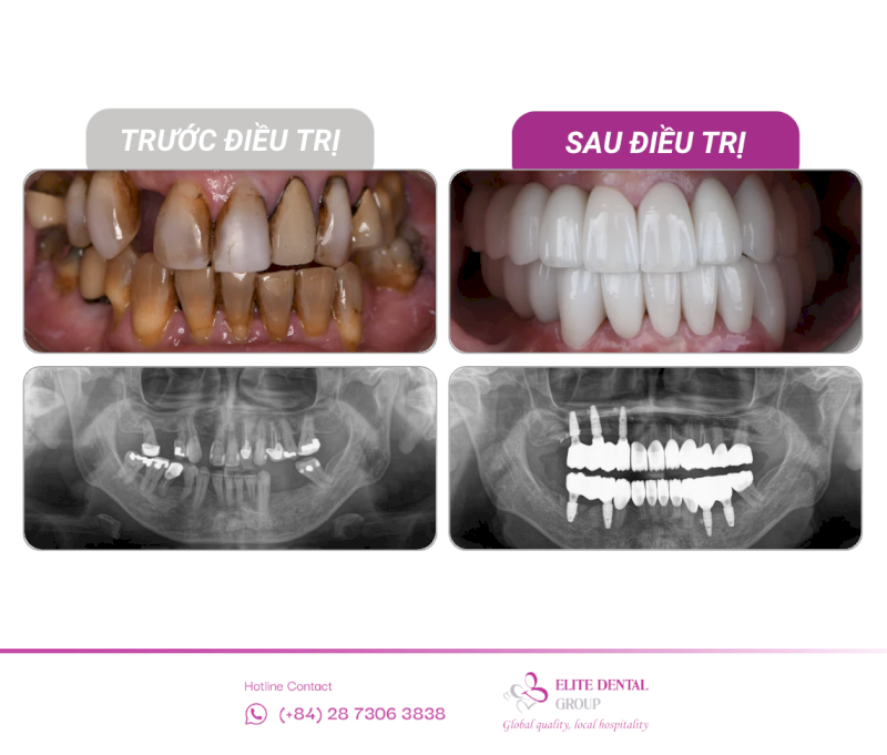Kỹ thuật Implant All-on-4 theo chuẩn Maló và ADA được chỉ định cho người mất răng toàn bộ hoặc viêm nha chu nặng