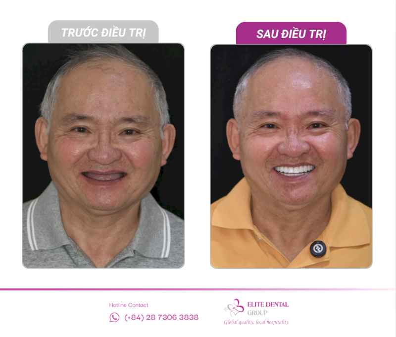 Implant All-on-4 tối ưu ăn nhai, thẩm mỹ và chi phí nhờ giảm số trụ, hạn chế ghép xương và ngăn tiêu xương tốt