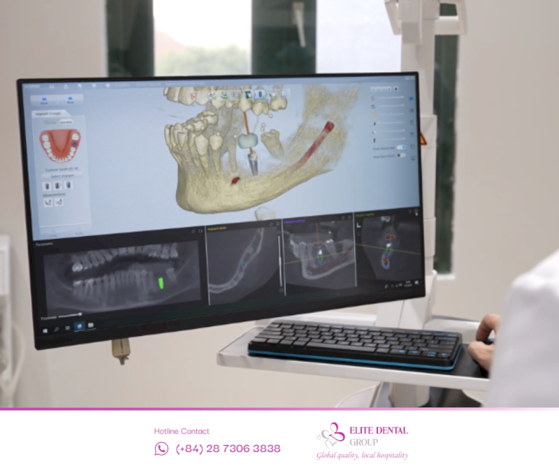 Lập kế hoạch cá nhân hóa, xử lý bệnh lý nền rồi cấy 4 trụ Implant chuẩn vô khuẩn 7 SOP kết hợp máng định vị