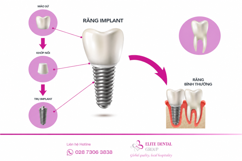 Trồng răng Implant Hàn Quốc là phương pháp phục hình răng tối ưu nên vấn đề làm răng Hàn Quốc giá bao nhiêu được nhiều khách hàng quan tâm