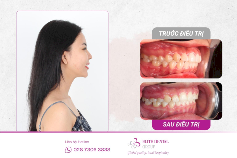 Hiệu quả niềng răng phụ thuộc vào tình trạng hô xương hàm
