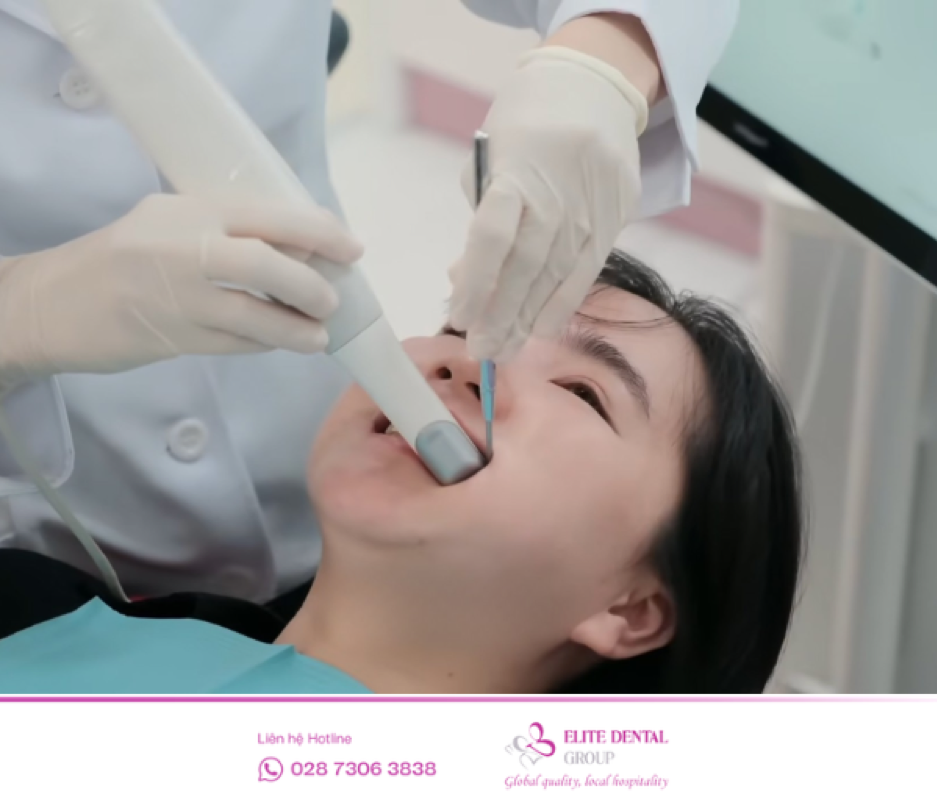 Lấy dấu kỹ thuật số giảm khó chịu so với phương pháp truyền thống
