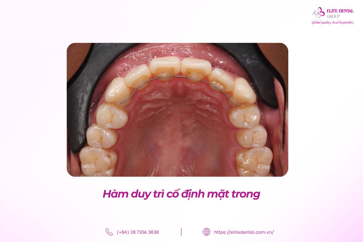 hàm duy trì cố định mặt trong