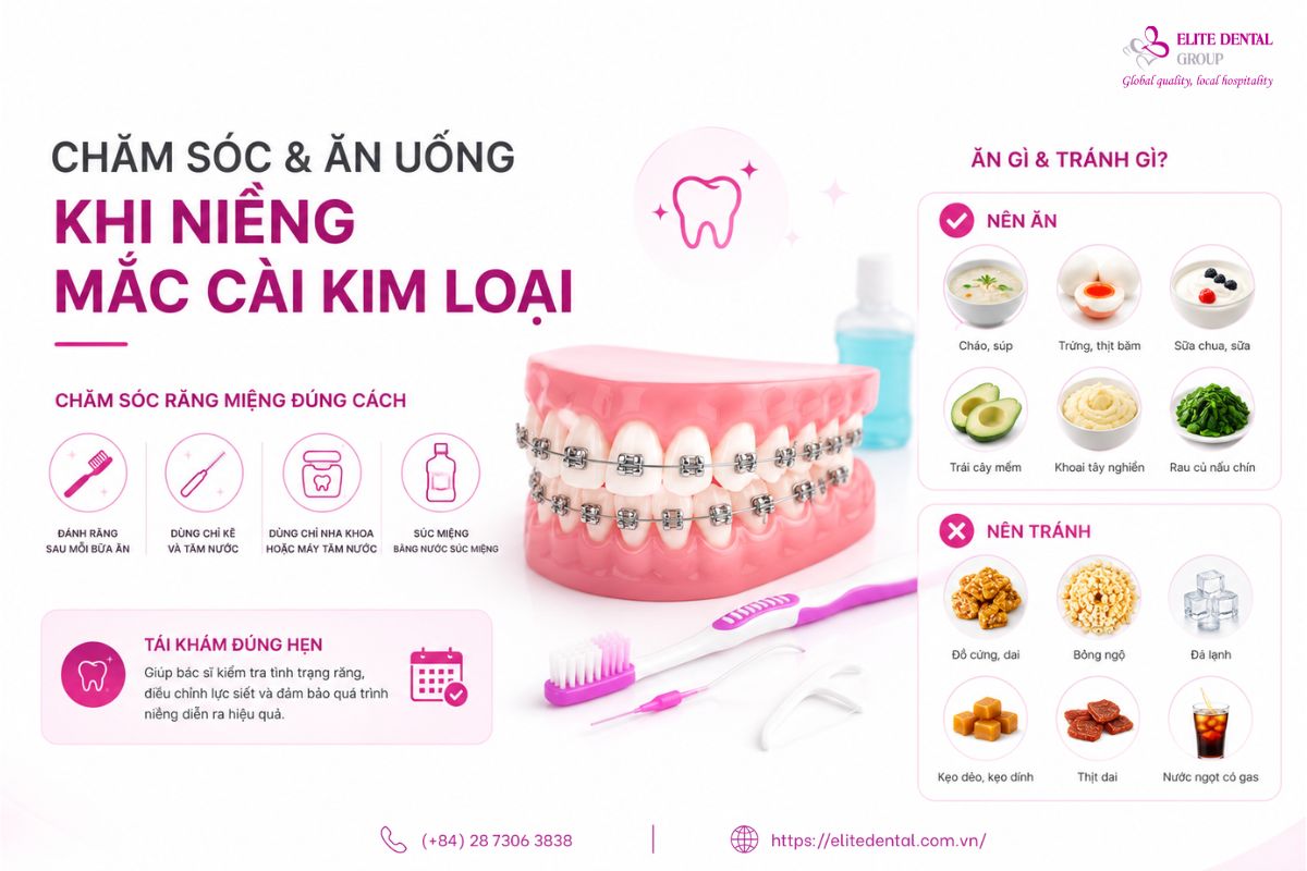 chăm sóc khi niềng răng mắc cài kim loại