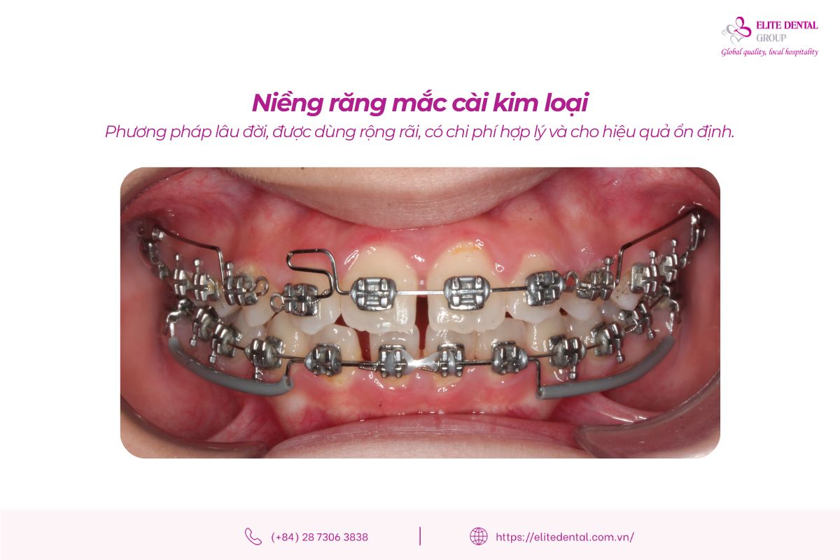 niềng răng mắc cài kim loại là gì