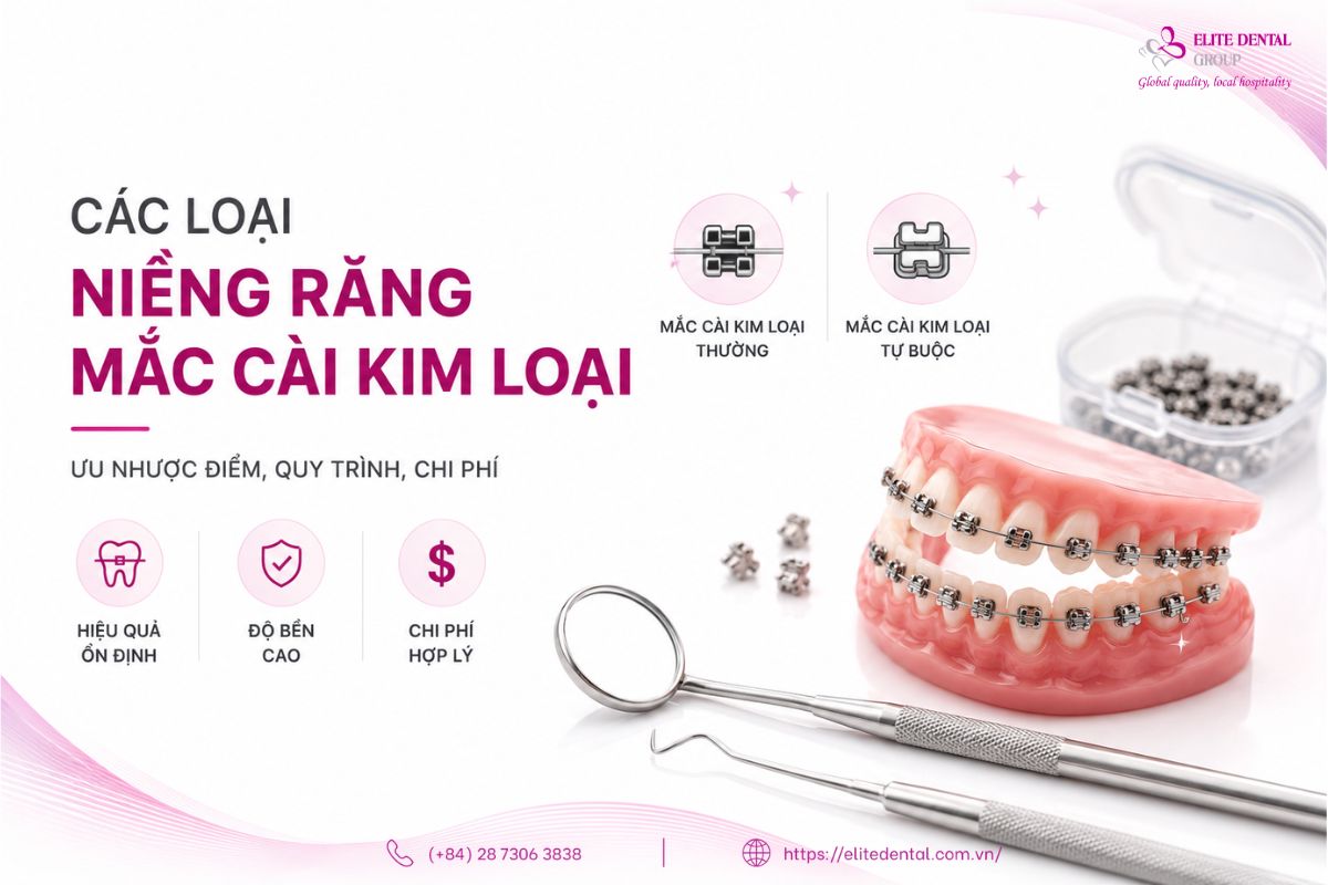 niềng răng mắc cài kim loại