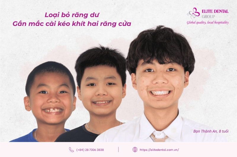răng thưa có niềng được không