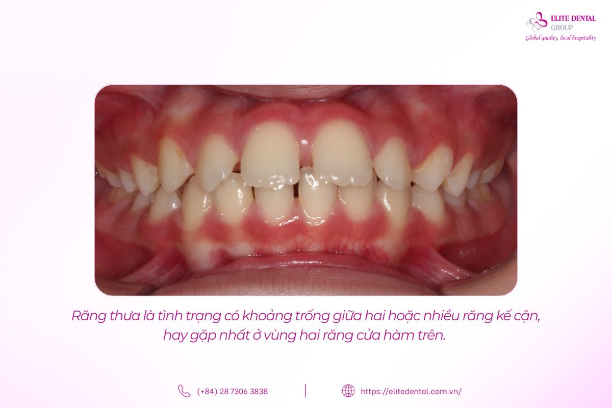 răng thưa là gì