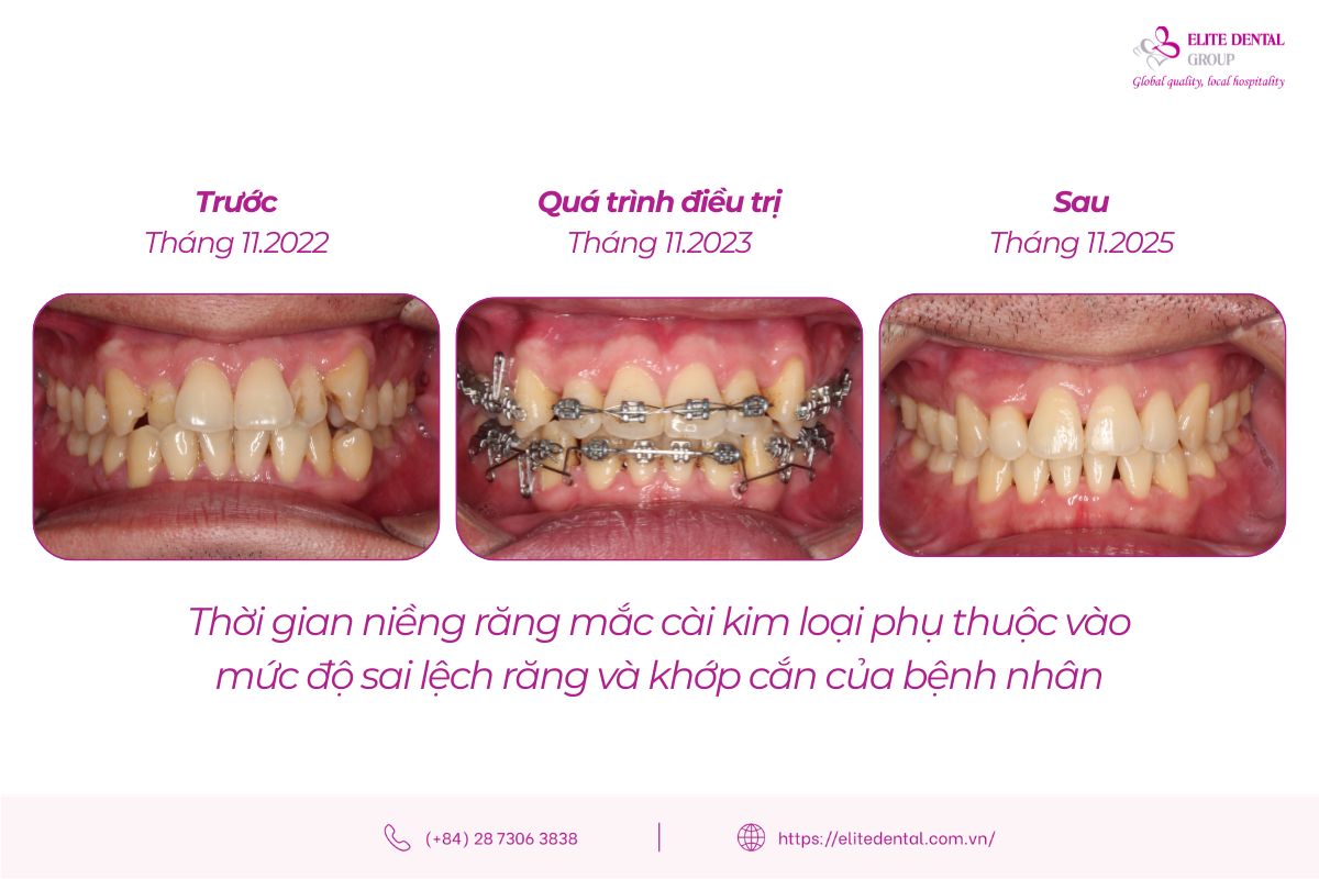 thời gian niềng răng mắc cài kim loại
