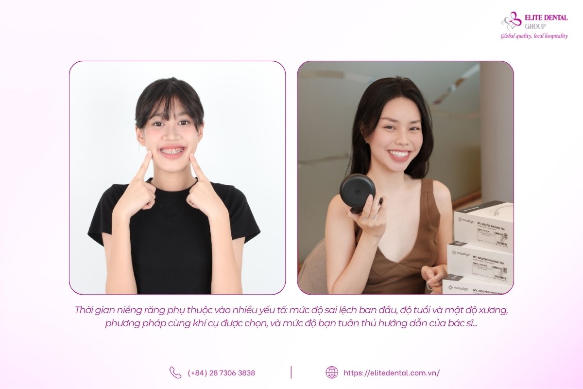 thời gian niềng răng phụ thuộc nhiều yếu tố