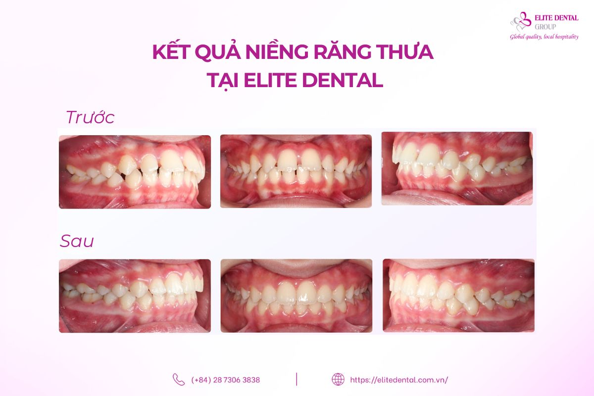 kết quả trước và sau khi niềng răng thưa tại elite dental