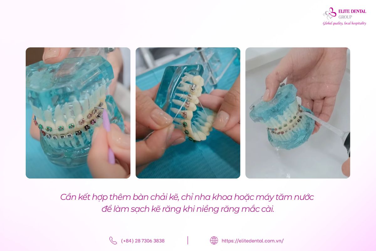 cách vệ sinh răng khi niềng răng mắc cài