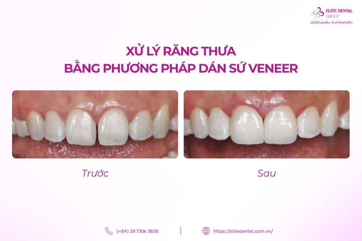 xử lý răng thưa bằng phương pháp dán sứ veneer