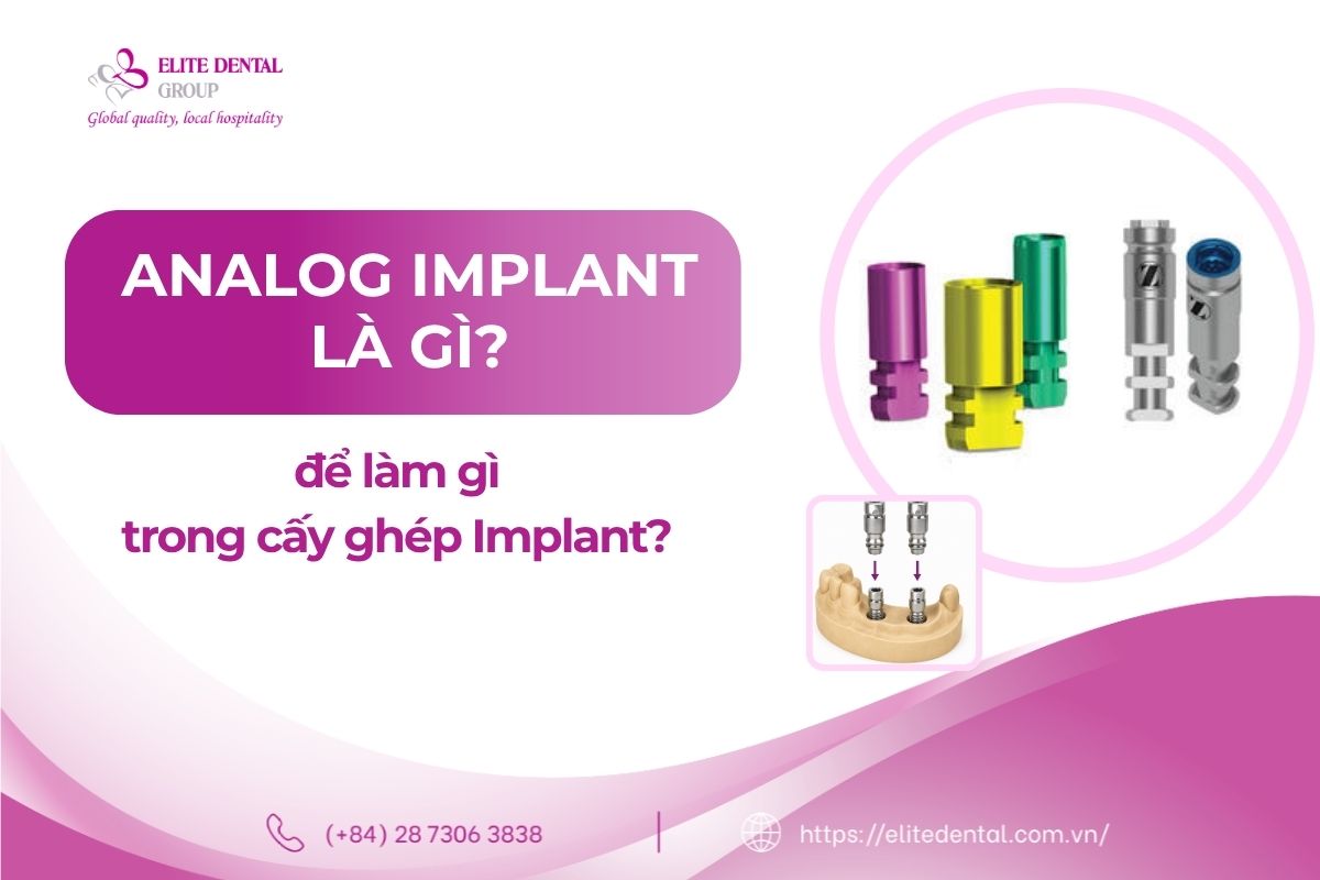 analog implant là gì