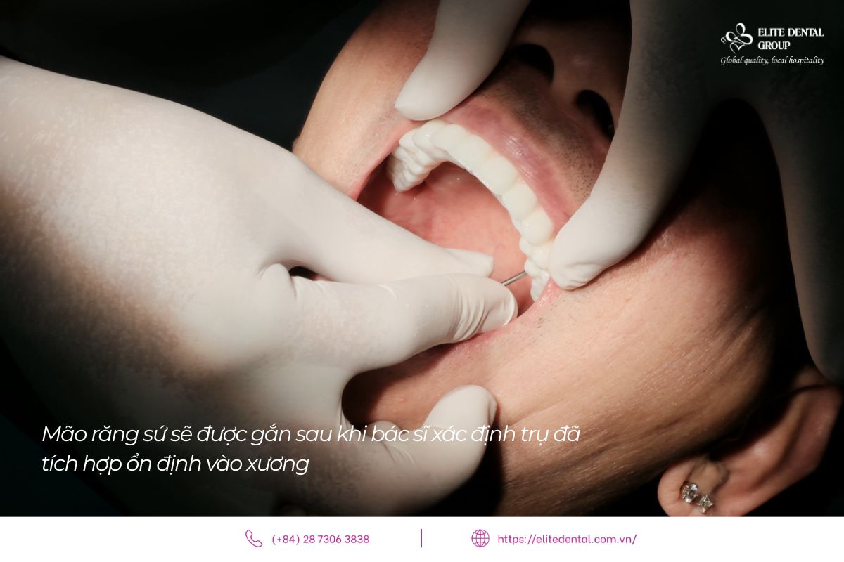 gắn răng sau khi trụ Implant đã tích hợp ổn định trong xương