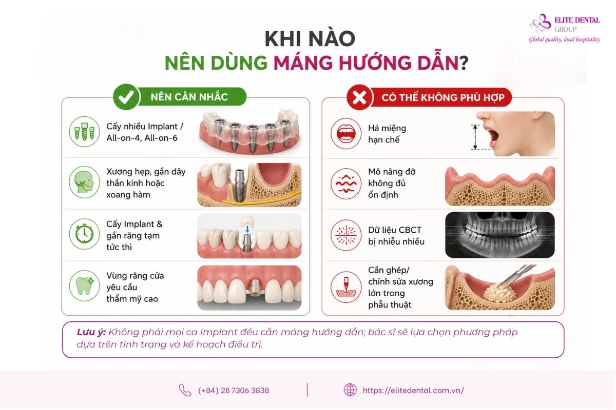 khi nào nên dùng máng hướng dẫn phẫu thuật đặt implant