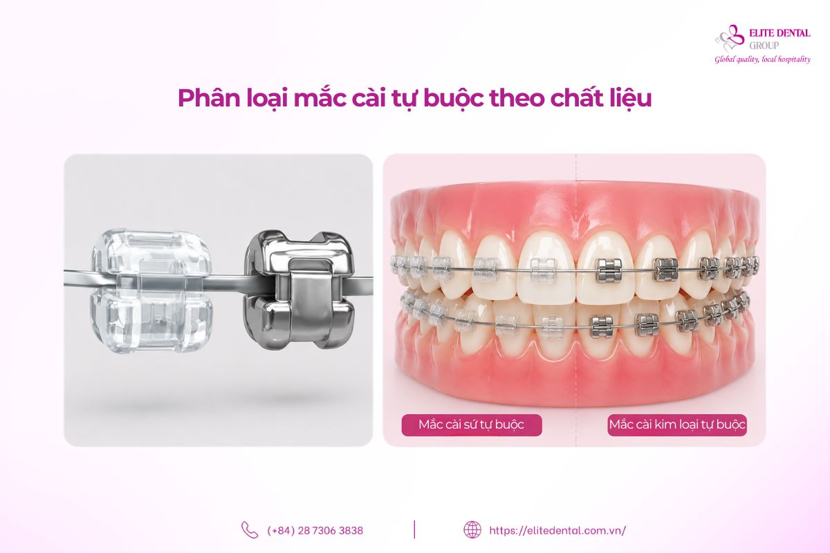 mắc cài kim loại tự buộc và mắc cài sứ tự buộc