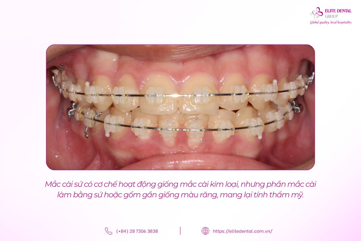 mắc cài sứ là gì