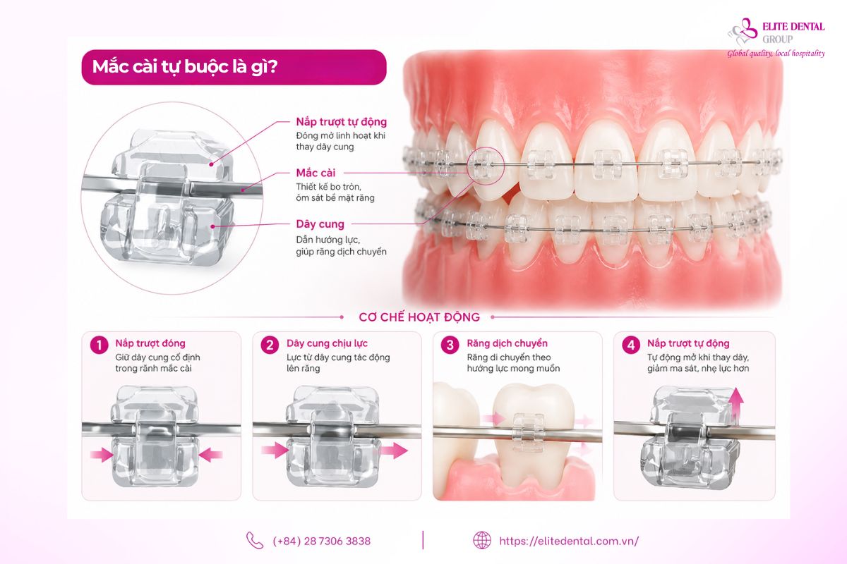 mắc cài tự buộc là gì