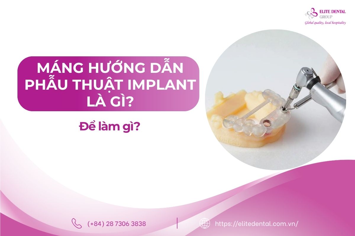 máng hướng dẫn phẫu thuật Implant