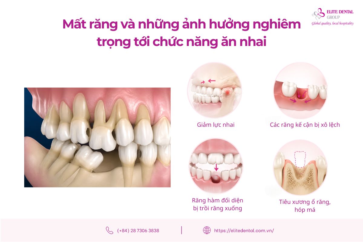 mất răng gây ảnh hưởng nghiêm trọng chức năng ăn nhai