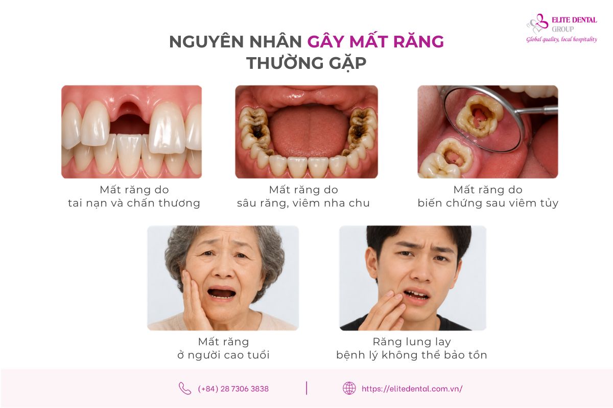 các nguyên nhân gây mất răng