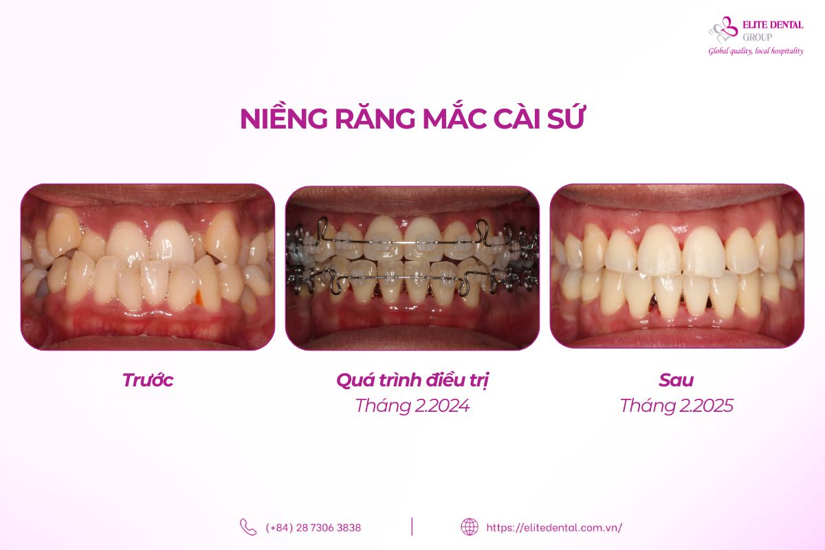niềng răng mắc cài sứ tại elite dental