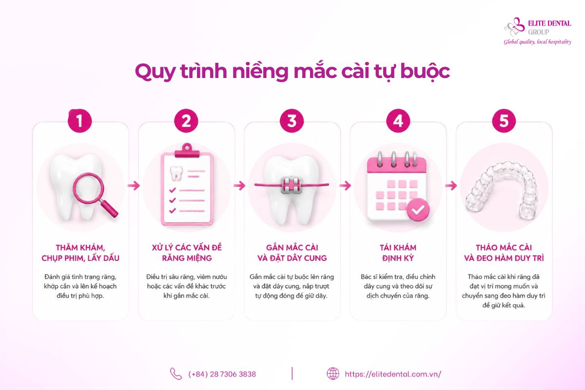 quy trình niềng mắc cài tự buộc