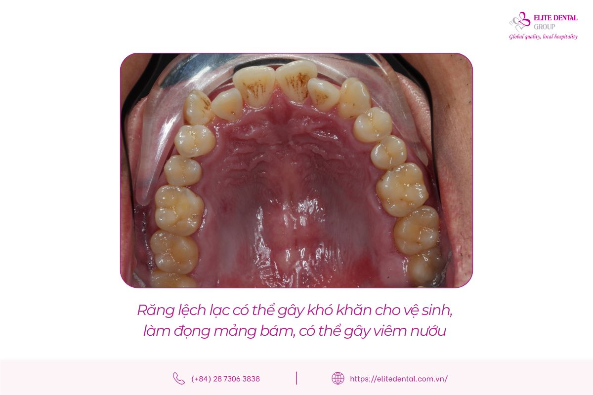 Răng khấp khểnh chen chúc gây khó vệ sinh