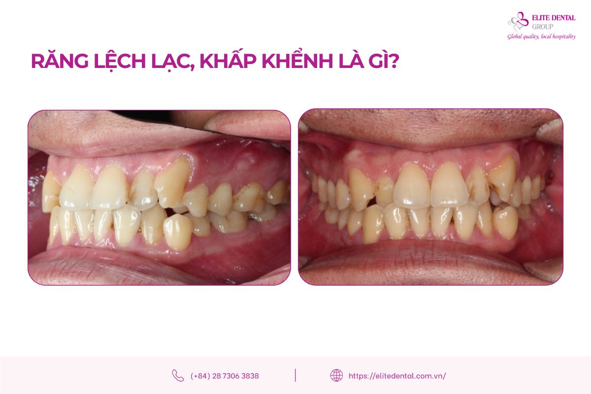 Răng khấp khểnh chen chúc là gì
