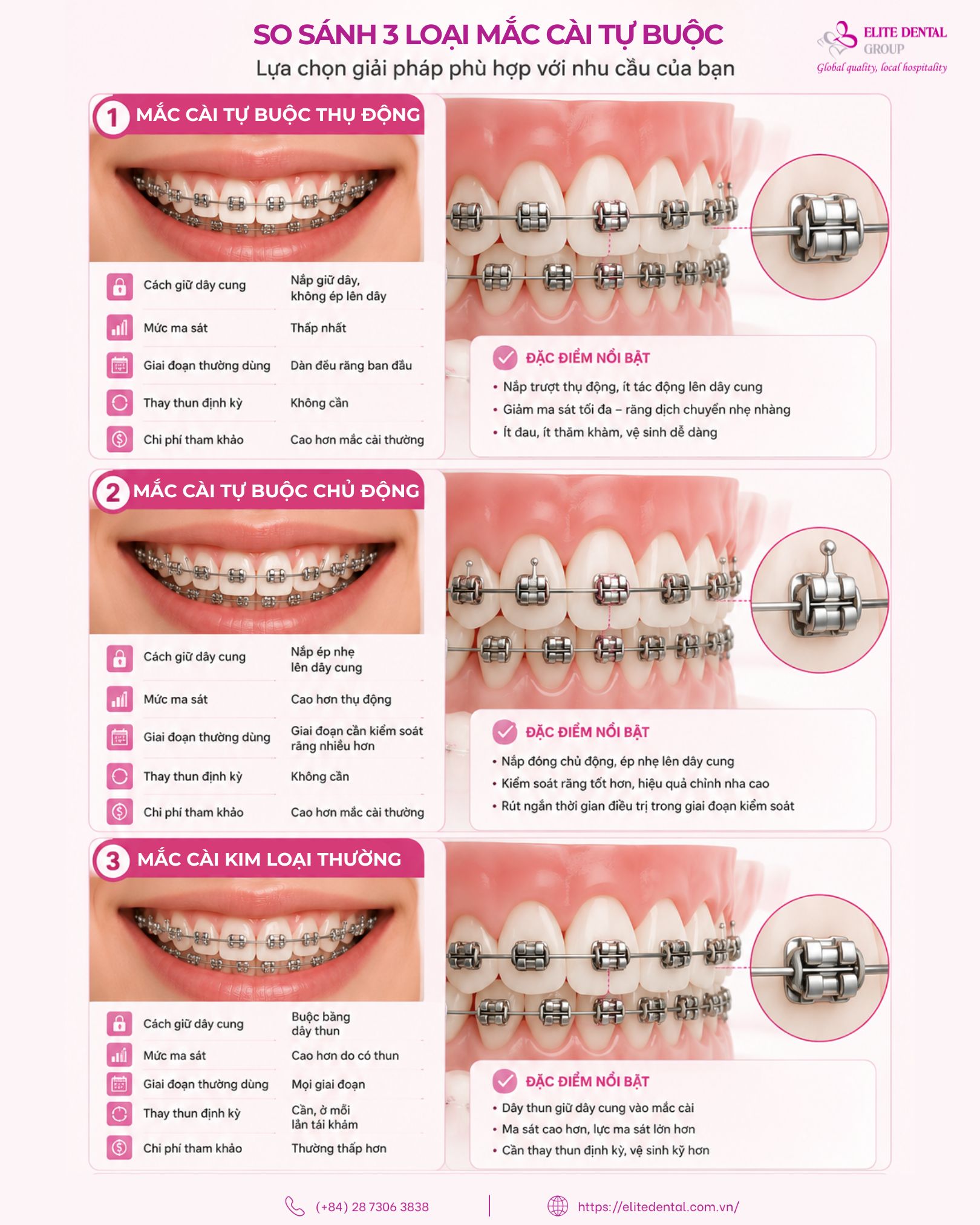so sánh các loại mắc cài tự động