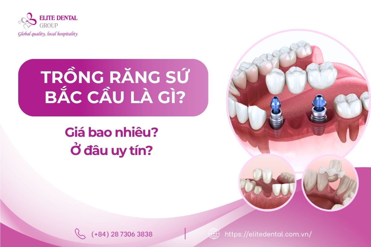 trồng răng bắc cầu là gì