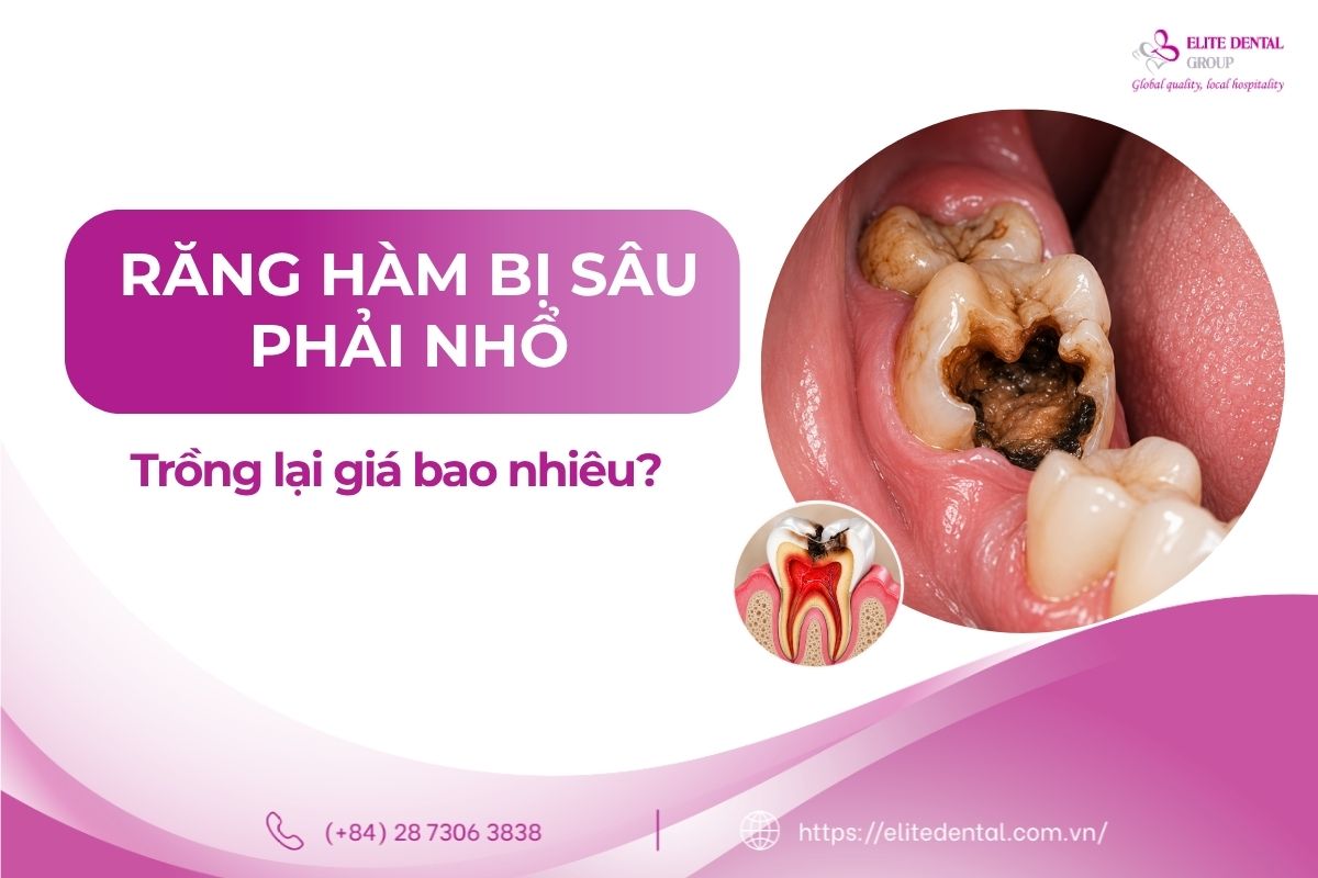 trồng răng hàm bị sâu giá bao nhiêu