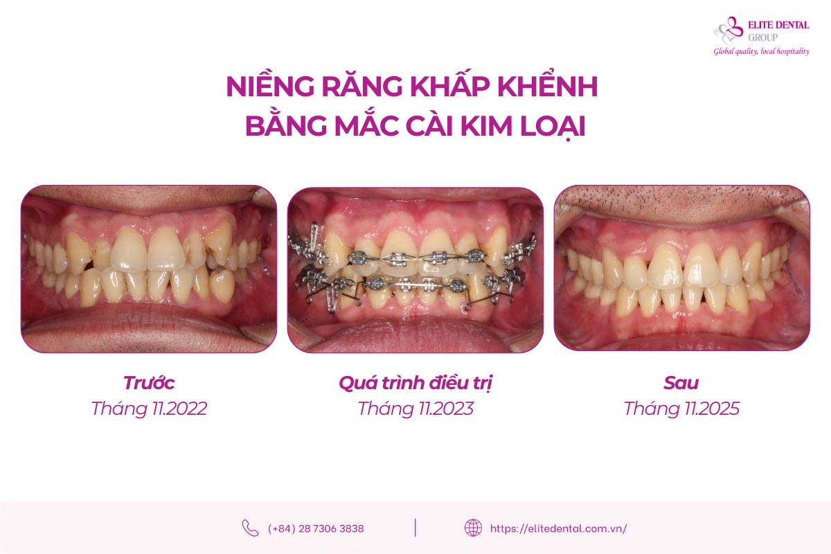 Trước và sau niềng răng khấp khểnh với mắc cài kim loại