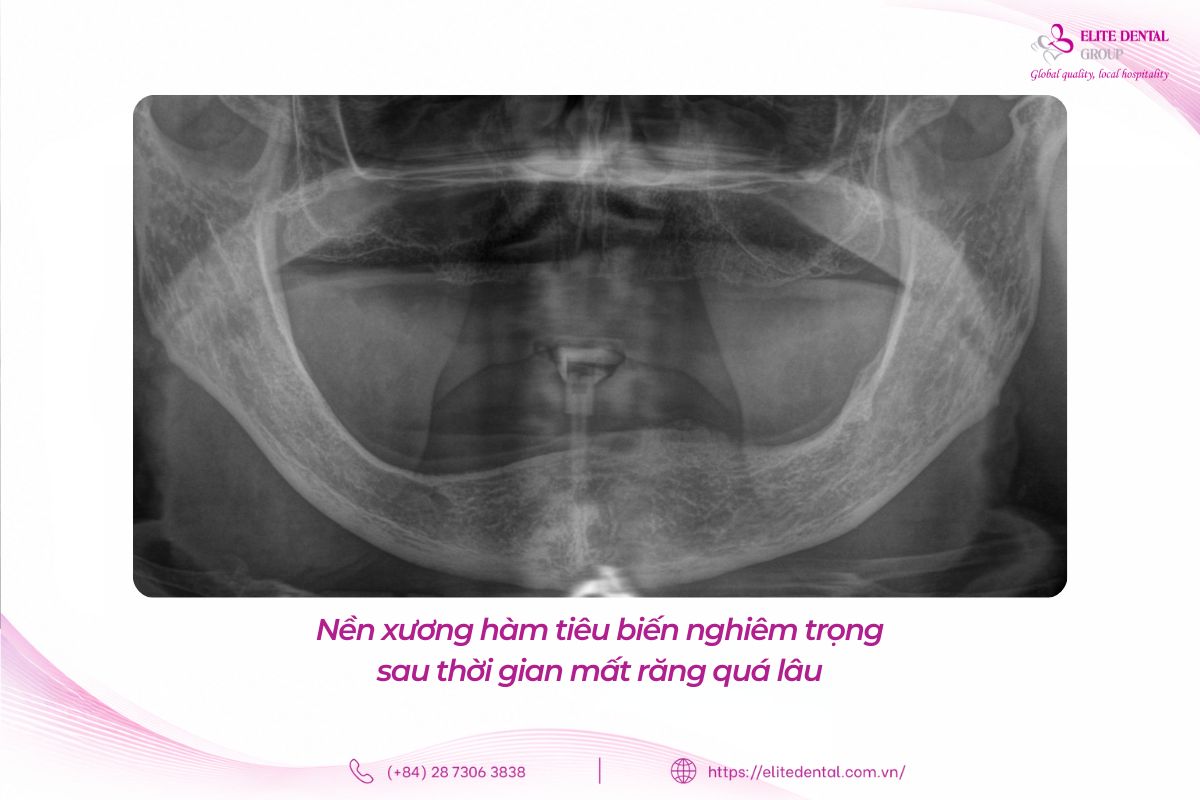 nguyên nhân mất răng lâu lại gây tiêu xương hàm